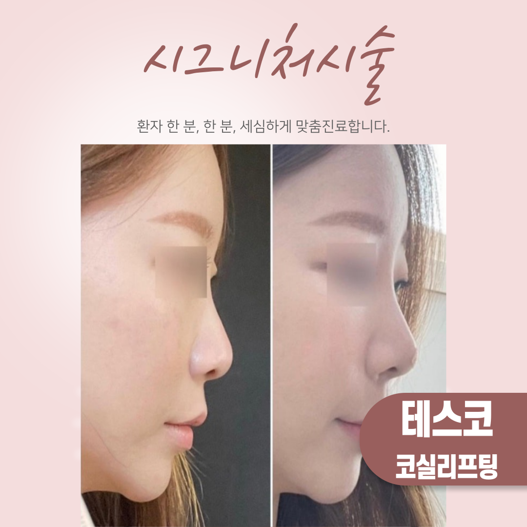 아이필유 시그니처 시술