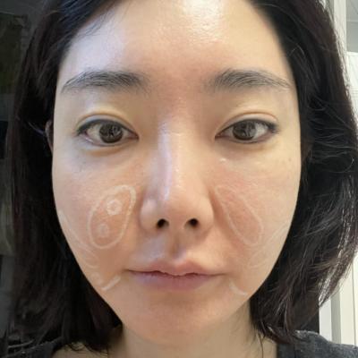 얼굴 살 없는 40대 , 어떤 리프팅 해야되나요?