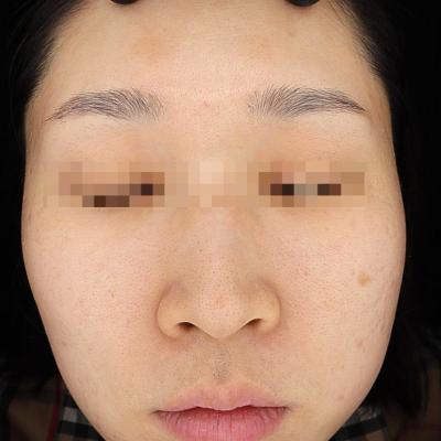 써마지 효과,모공, 잔주름 , 광채개선 , 마크뷰 전후 사진 비교 , 유지기간