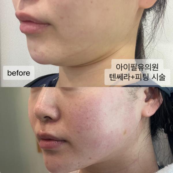 텐쎄라 600라인+피팅리프팅 6만줄